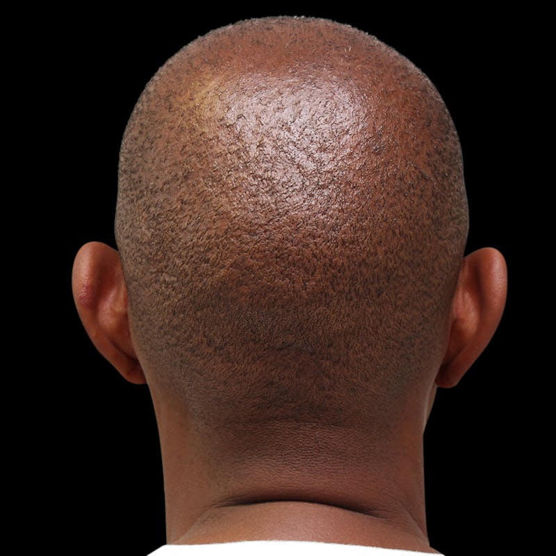 Otoplasty Before & After Gallery - Patient 309717 - Image 3