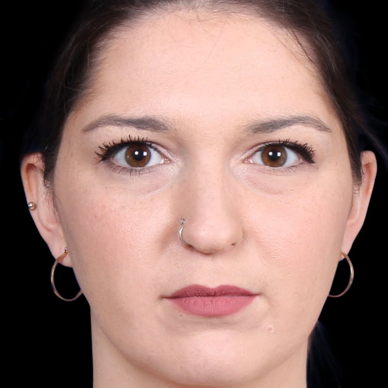 Rhinoplasty Before & After Gallery - Patient 373779 - Image 9