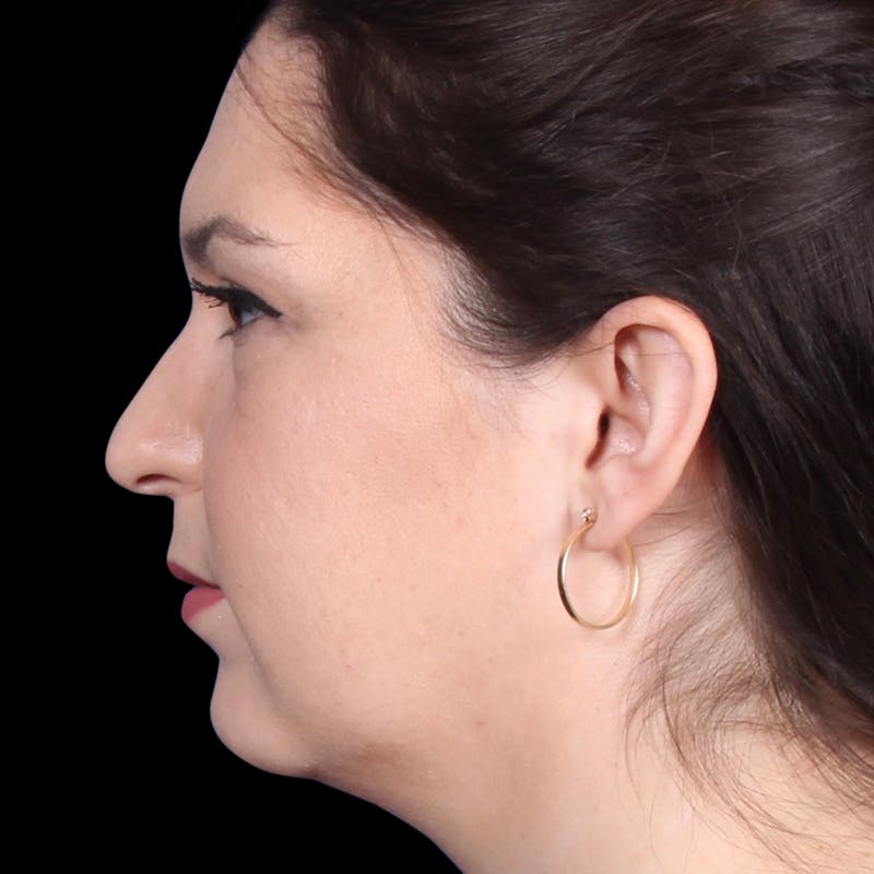 Rhinoplasty Before & After Gallery - Patient 373779 - Image 1