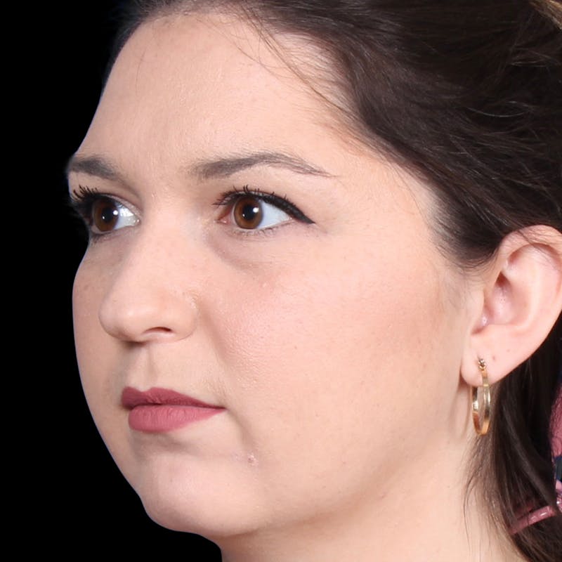 Rhinoplasty Before & After Gallery - Patient 373779 - Image 3