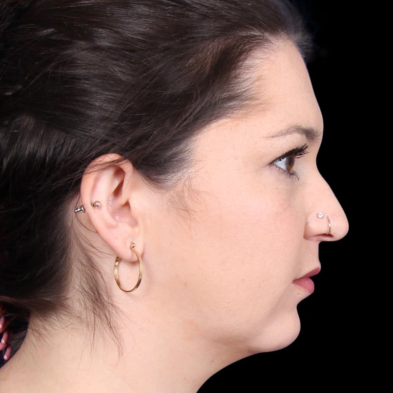 Rhinoplasty Before & After Gallery - Patient 373779 - Image 5