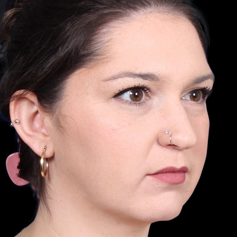 Rhinoplasty Before & After Gallery - Patient 373779 - Image 7