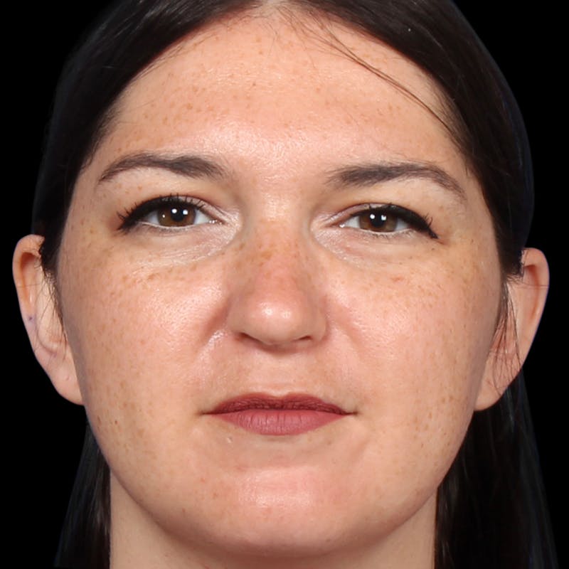 Rhinoplasty Before & After Gallery - Patient 373779 - Image 10