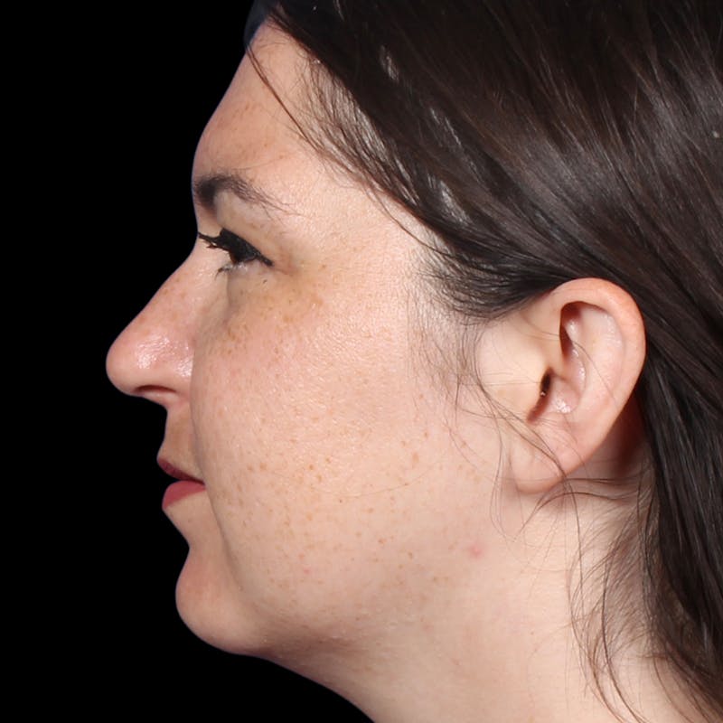 Rhinoplasty Before & After Gallery - Patient 373779 - Image 2