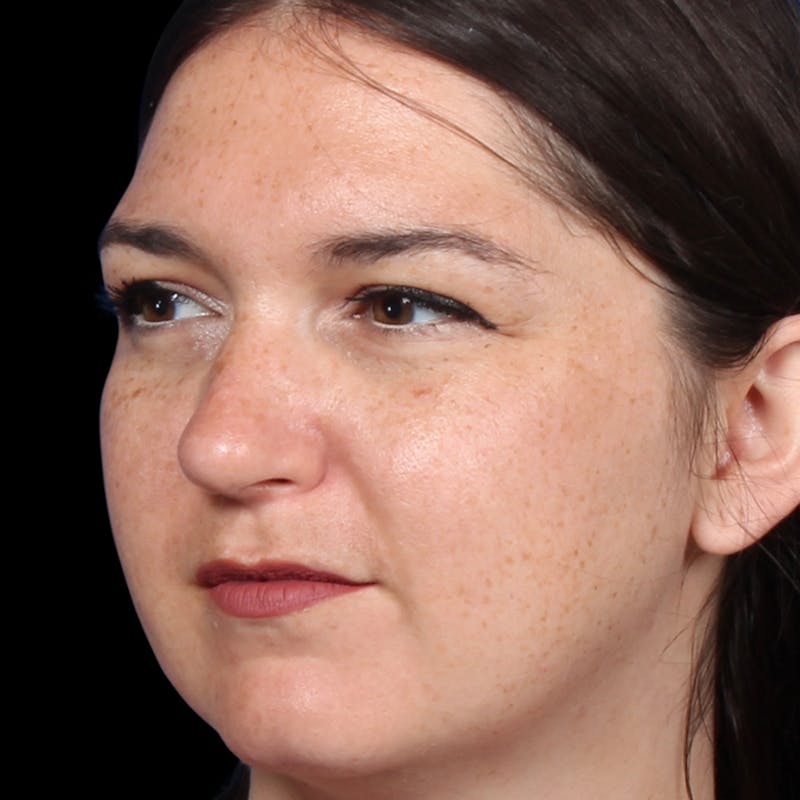 Rhinoplasty Before & After Gallery - Patient 373779 - Image 4