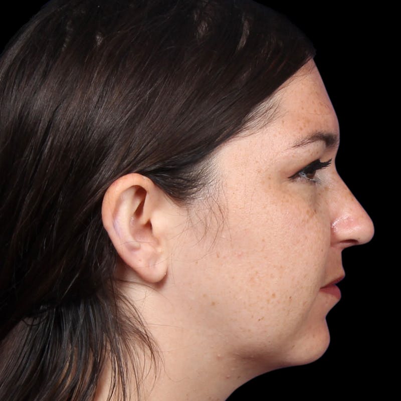Rhinoplasty Before & After Gallery - Patient 373779 - Image 6