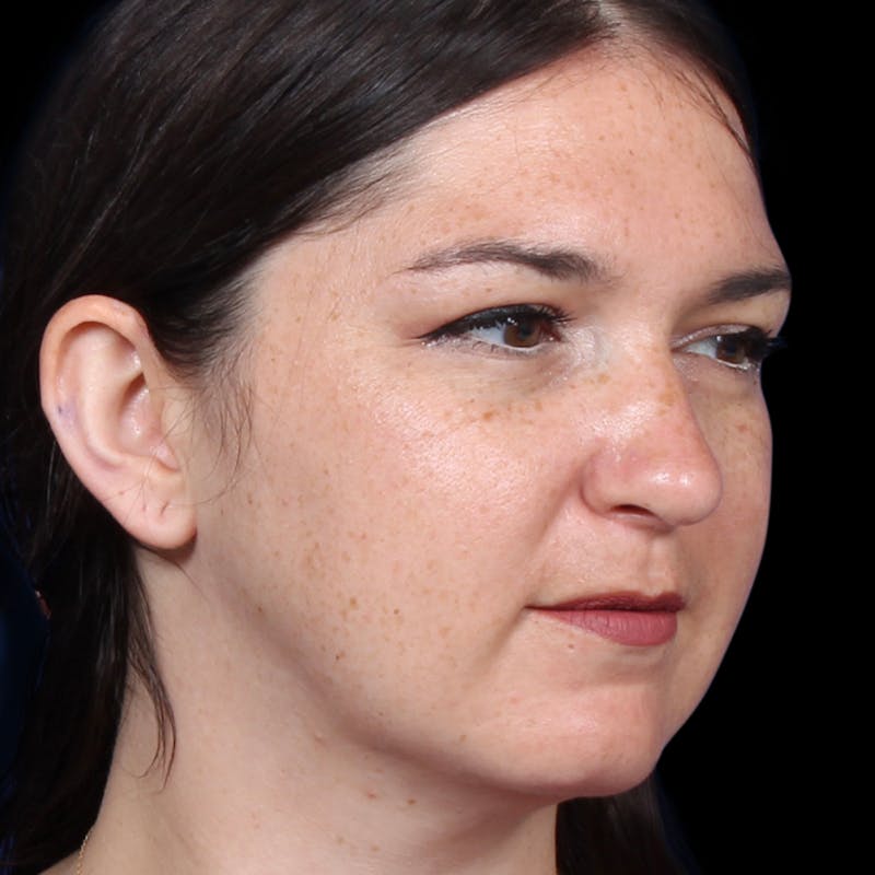 Rhinoplasty Before & After Gallery - Patient 373779 - Image 8
