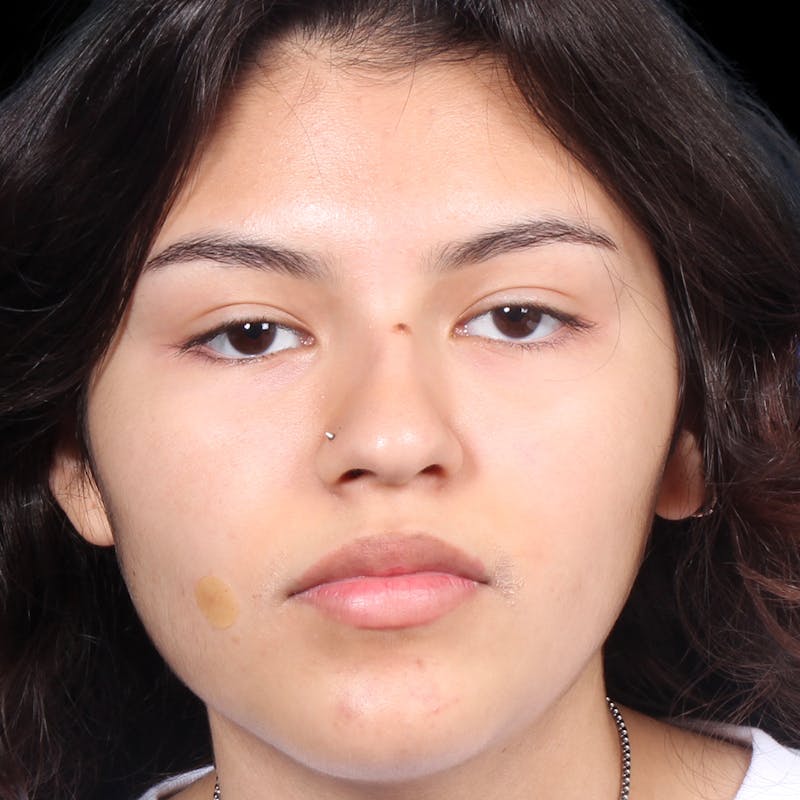 Rhinoplasty Before & After Gallery - Patient 216267 - Image 5