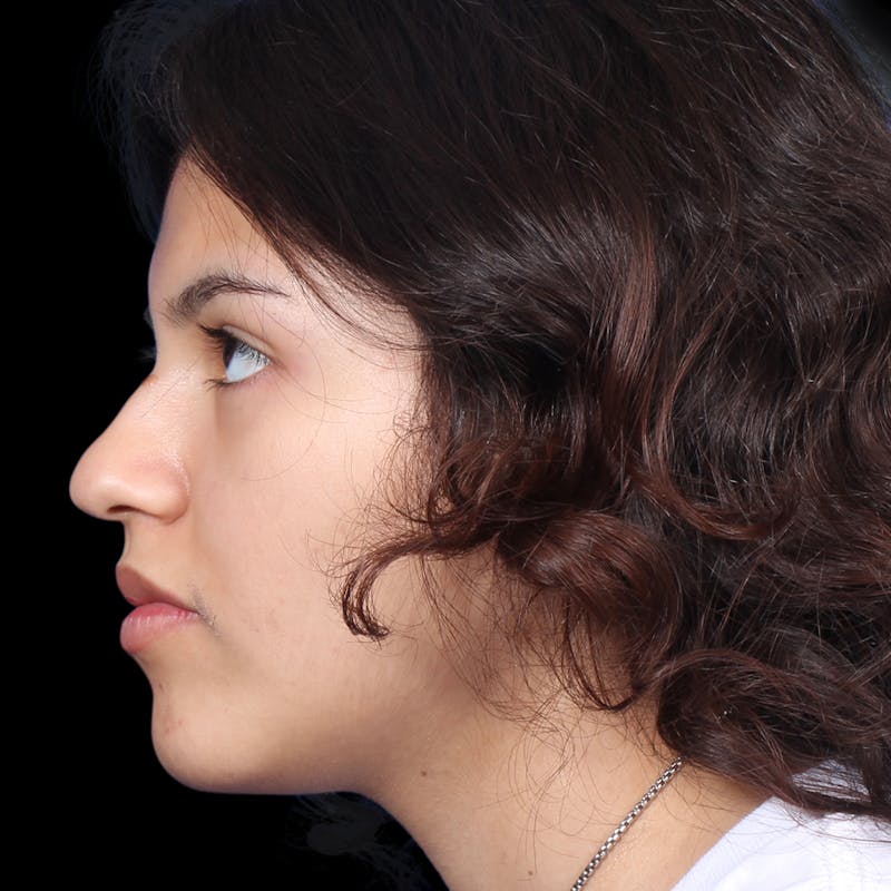 Rhinoplasty Before & After Gallery - Patient 216267 - Image 1