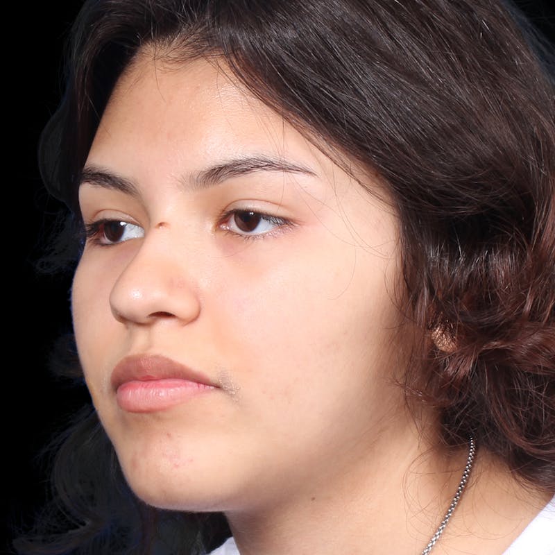 Rhinoplasty Before & After Gallery - Patient 216267 - Image 3