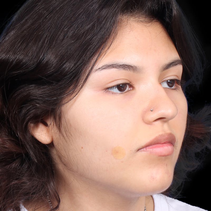 Rhinoplasty Before & After Gallery - Patient 216267 - Image 9