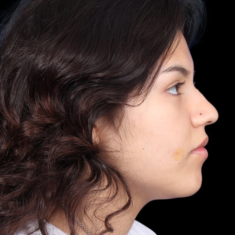 Rhinoplasty Before & After Gallery - Patient 216267 - Image 7