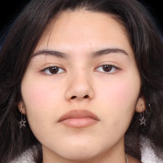 Rhinoplasty Before & After Gallery - Patient 216267 - Image 6