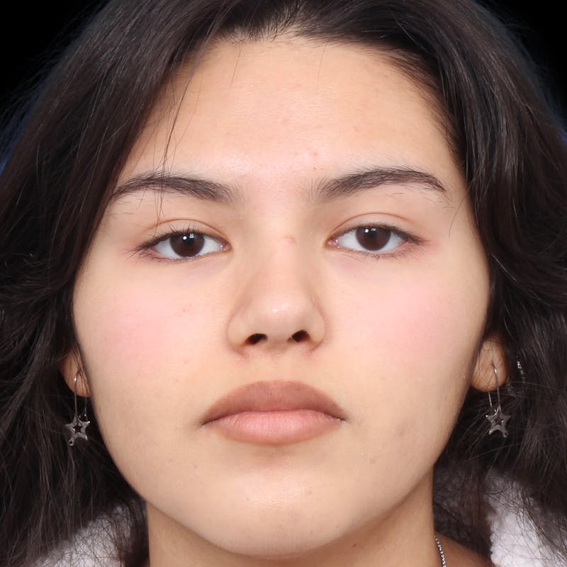 Rhinoplasty Before & After Gallery - Patient 216267 - Image 6