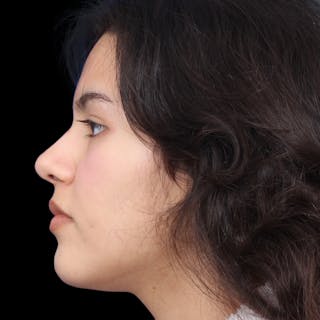 Rhinoplasty Before & After Gallery - Patient 216267 - Image 2