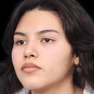 Rhinoplasty Before & After Gallery - Patient 216267 - Image 4