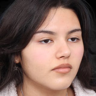 Rhinoplasty Before & After Gallery - Patient 216267 - Image 10