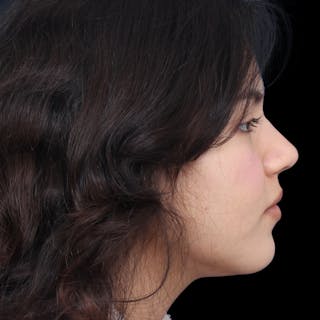 Rhinoplasty Before & After Gallery - Patient 216267 - Image 8