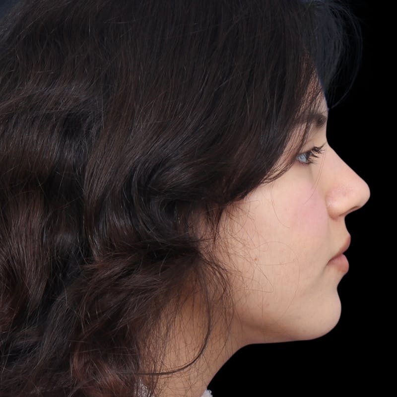 Rhinoplasty Before & After Gallery - Patient 216267 - Image 8