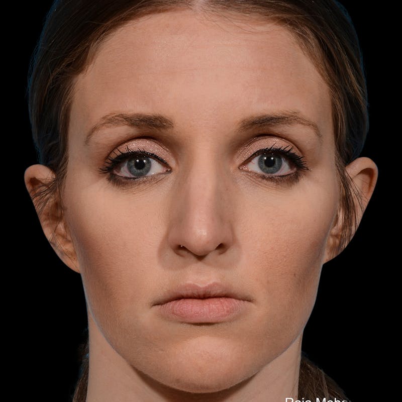 Rhinoplasty Before & After Gallery - Patient 365676 - Image 5