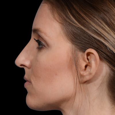 Rhinoplasty Before & After Gallery - Patient 365676 - Image 1