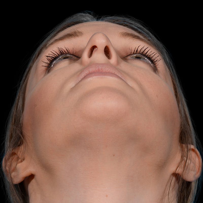Rhinoplasty Before & After Gallery - Patient 365676 - Image 3