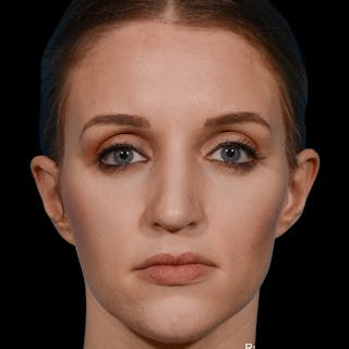 Rhinoplasty Before & After Gallery - Patient 365676 - Image 6