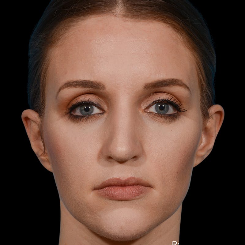 Rhinoplasty Before & After Gallery - Patient 365676 - Image 6