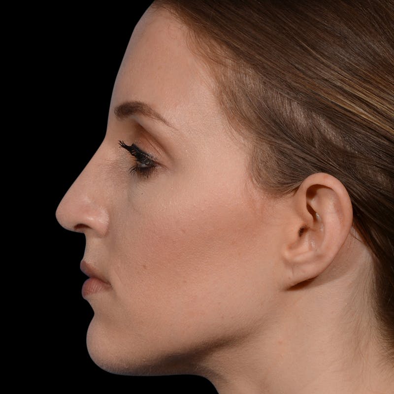 Rhinoplasty Before & After Gallery - Patient 365676 - Image 2