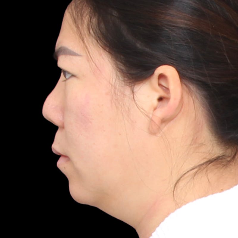 Rhinoplasty Before & After Gallery - Patient 290238 - Image 1