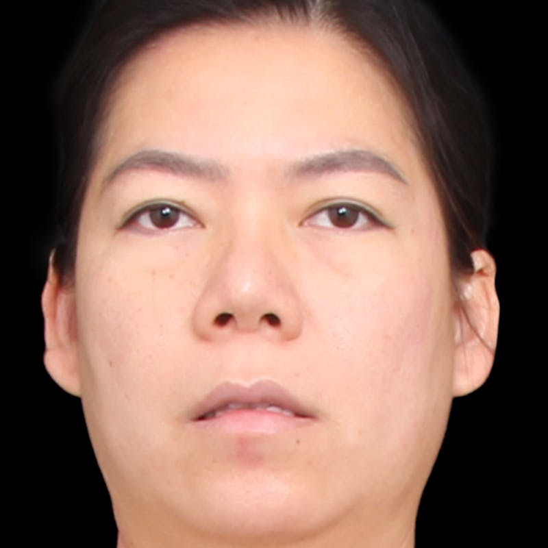 Rhinoplasty Before & After Gallery - Patient 290238 - Image 7