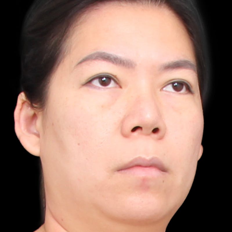 Rhinoplasty Before & After Gallery - Patient 290238 - Image 3