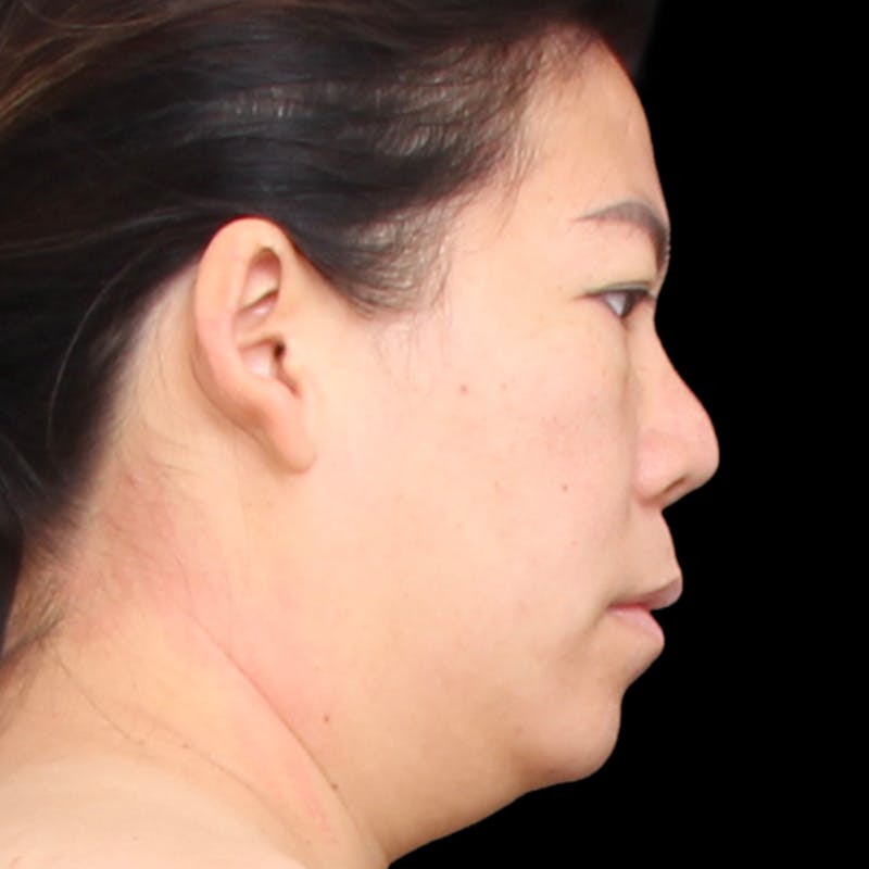 Rhinoplasty Before & After Gallery - Patient 290238 - Image 5