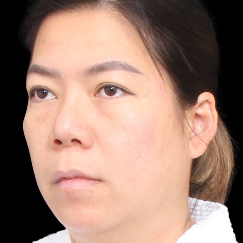 Rhinoplasty Before & After Gallery - Patient 290238 - Image 9