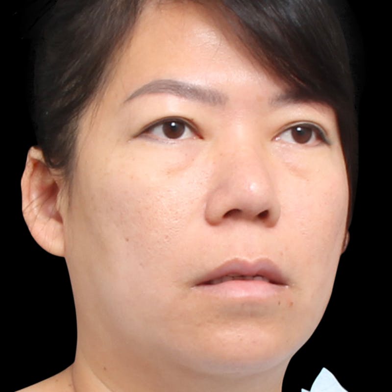 Rhinoplasty Before & After Gallery - Patient 290238 - Image 4