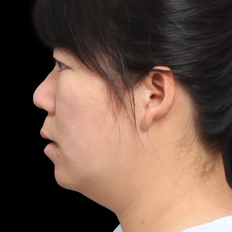 Rhinoplasty Before & After Gallery - Patient 290238 - Image 2