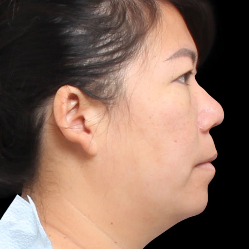 Rhinoplasty Before & After Gallery - Patient 290238 - Image 6