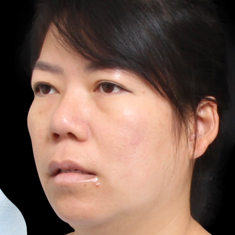 Rhinoplasty Before & After Gallery - Patient 290238 - Image 10