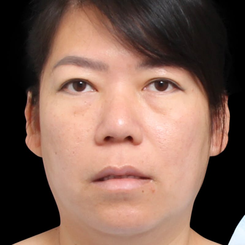 Rhinoplasty Before & After Gallery - Patient 290238 - Image 8
