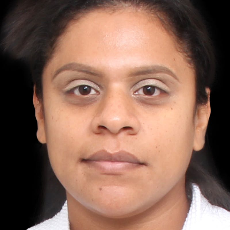 Rhinoplasty Before & After Gallery - Patient 113277 - Image 5
