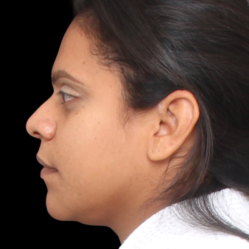 Rhinoplasty Before & After Gallery - Patient 113277 - Image 1