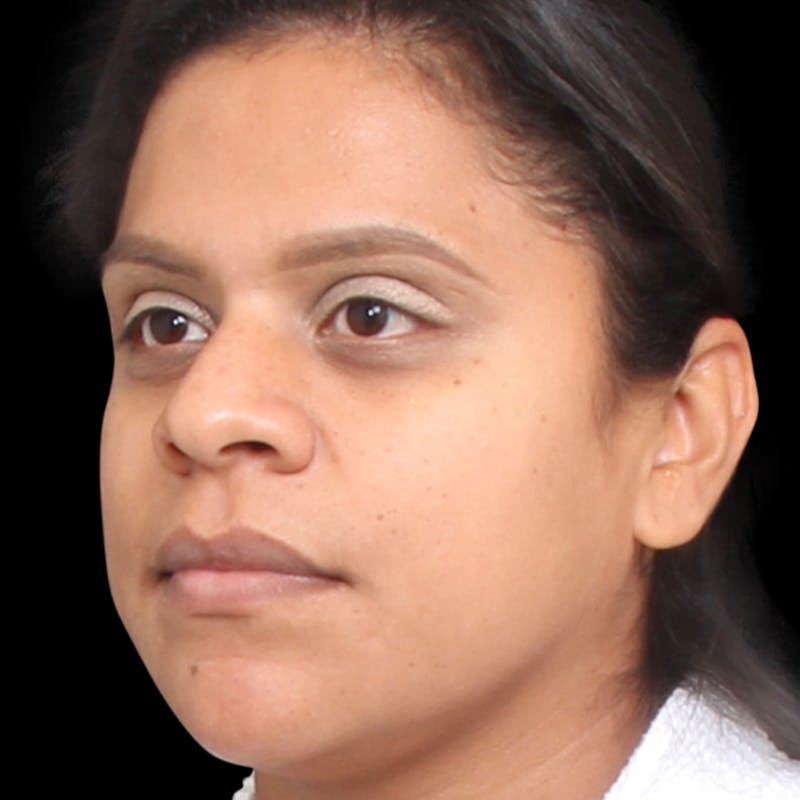 Rhinoplasty Before & After Gallery - Patient 113277 - Image 7