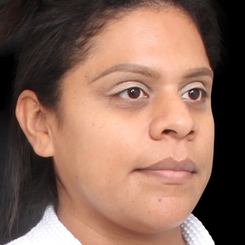 Rhinoplasty Before & After Gallery - Patient 113277 - Image 3