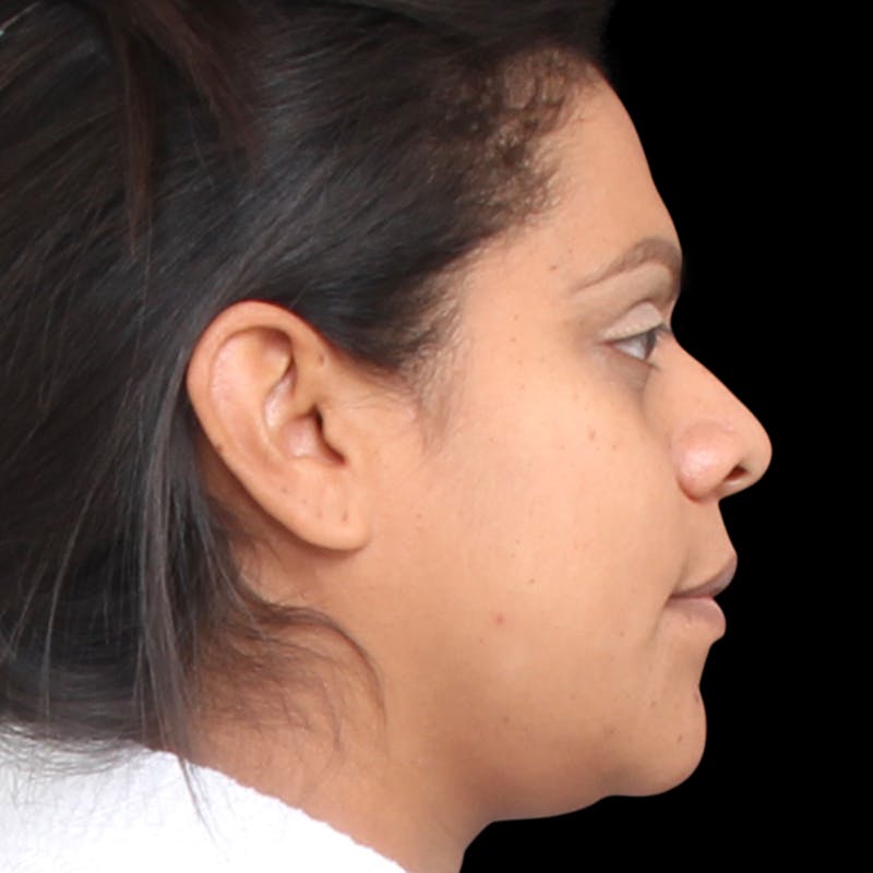 Rhinoplasty Before & After Gallery - Patient 113277 - Image 9
