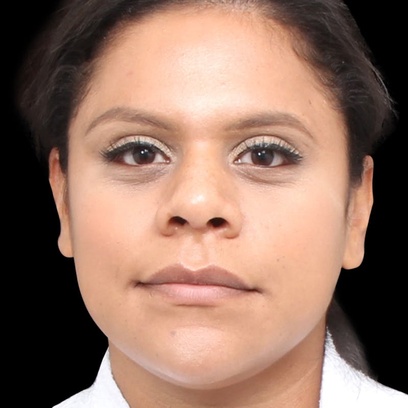 Rhinoplasty Before & After Gallery - Patient 113277 - Image 6