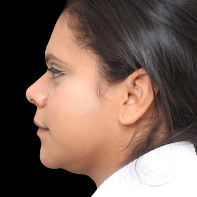 Rhinoplasty Before & After Gallery - Patient 113277 - Image 2