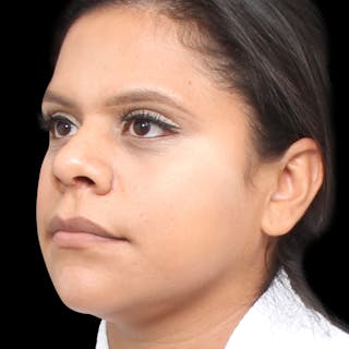 Rhinoplasty Before & After Gallery - Patient 113277 - Image 8