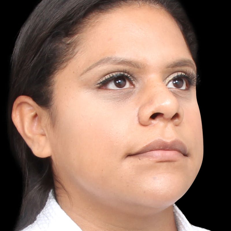 Rhinoplasty Before & After Gallery - Patient 113277 - Image 4