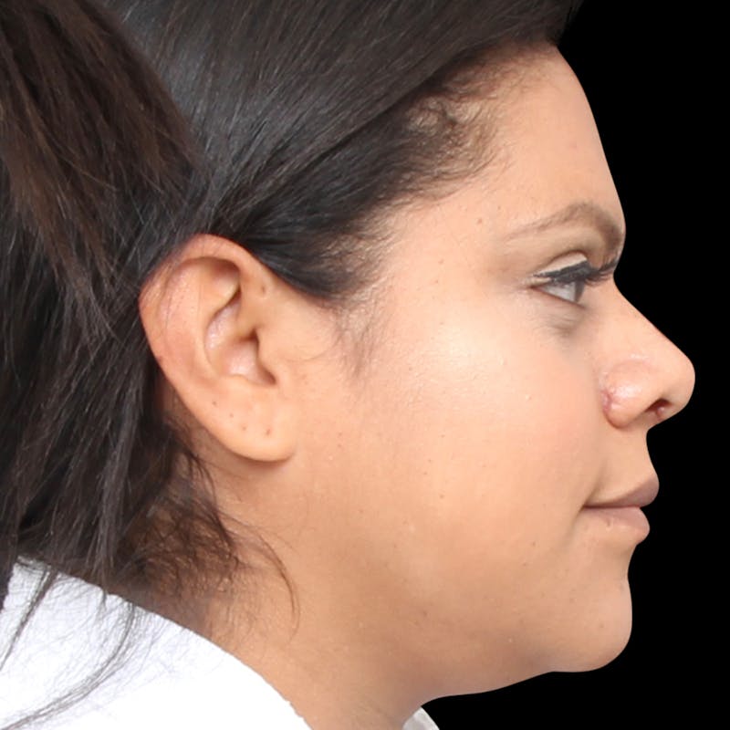 Rhinoplasty Before & After Gallery - Patient 113277 - Image 10