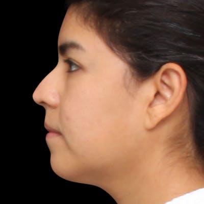 Rhinoplasty Before & After Gallery - Patient 662876 - Image 1